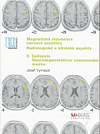 Magnetická rezonance nervové soustavy - radiologické a klinické aspekty. II, Epilepsie, neurodegenerativní onemocnění mozku