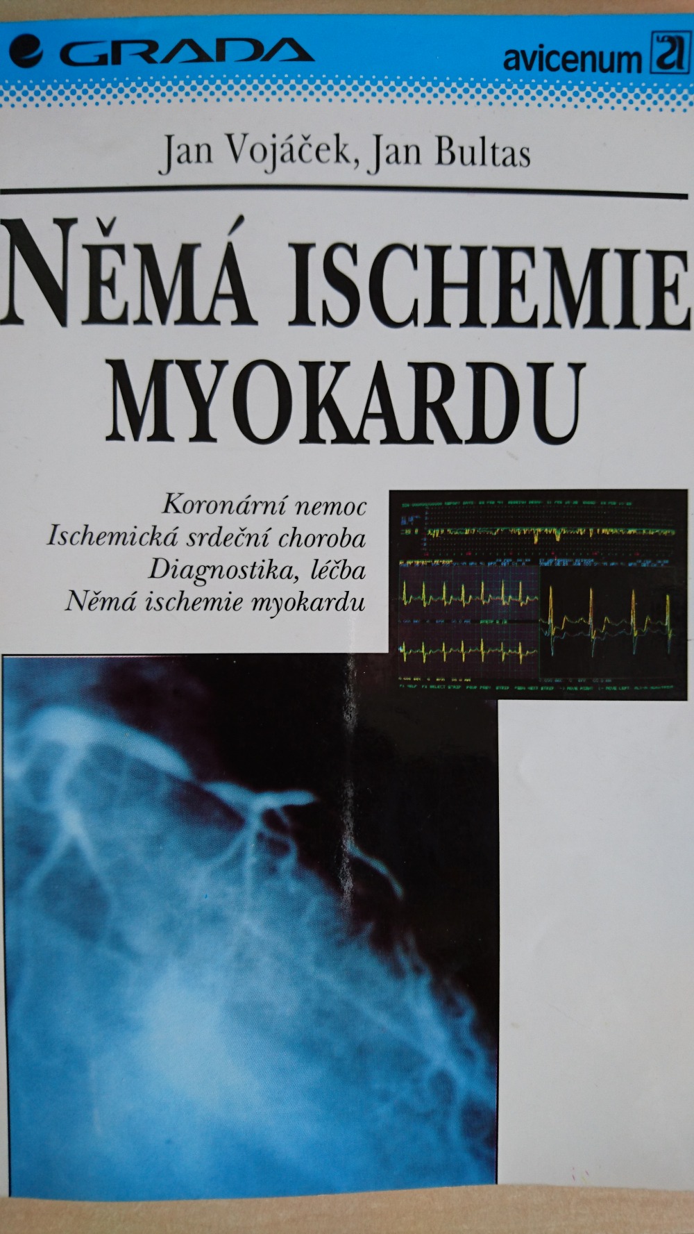 Němá ischemie myokardu