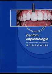 Dentální implantologie