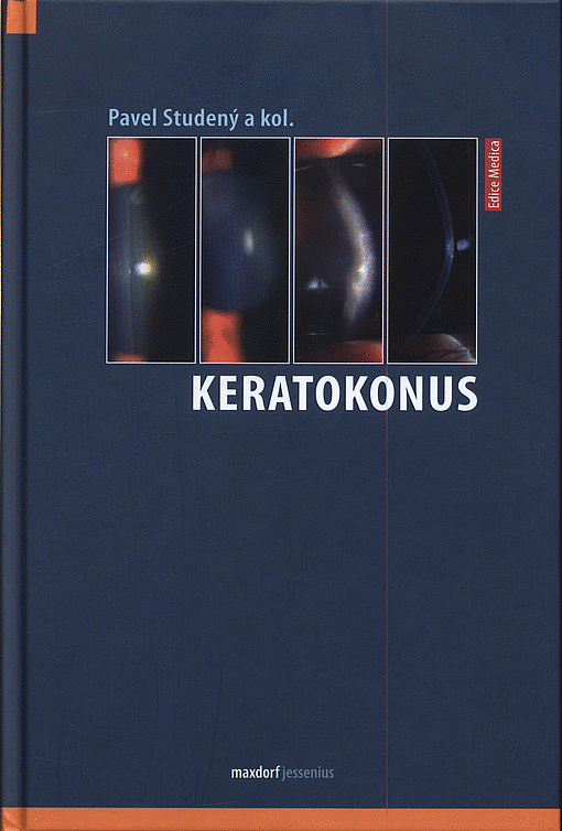 Keratokonus